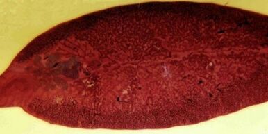 Fluke-Parasiten, wie man ihn aus dem Körper entfernt