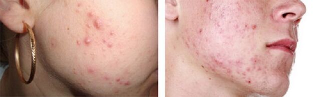 Hautausschlag als Symptom für das Vorhandensein subkutaner Würmer